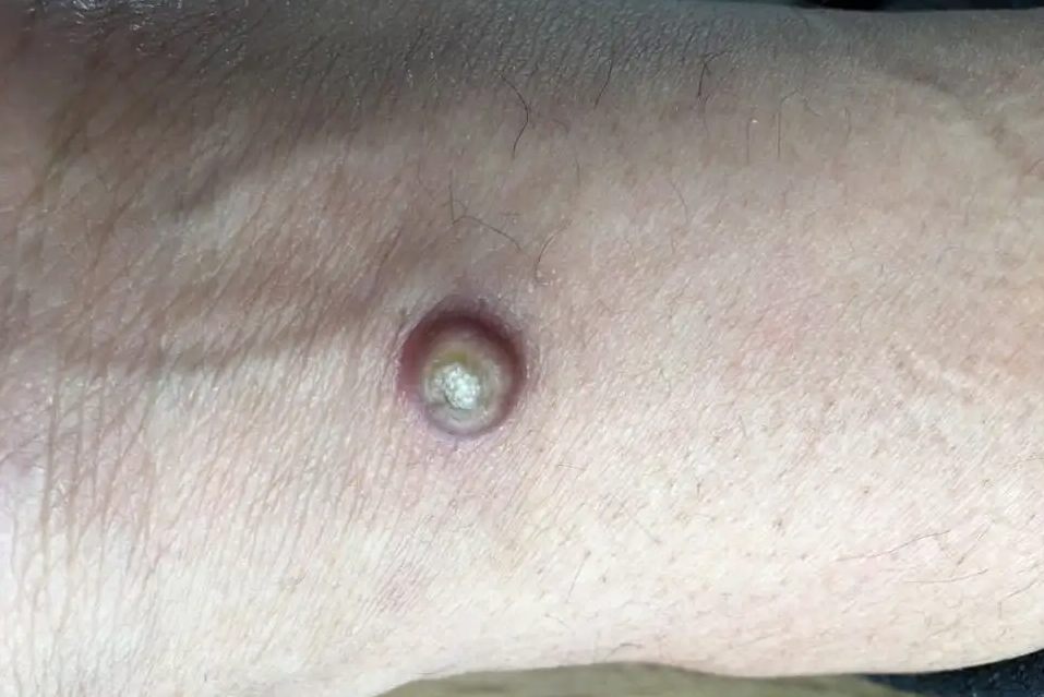 单发型角化棘皮瘤