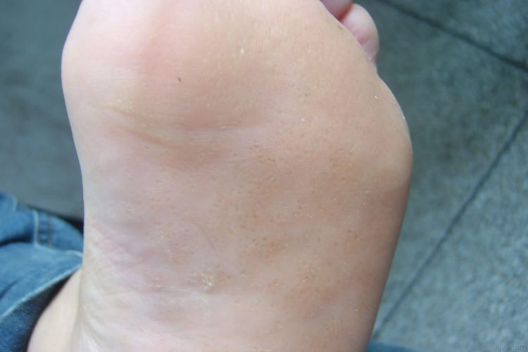 点状掌跖角化病图