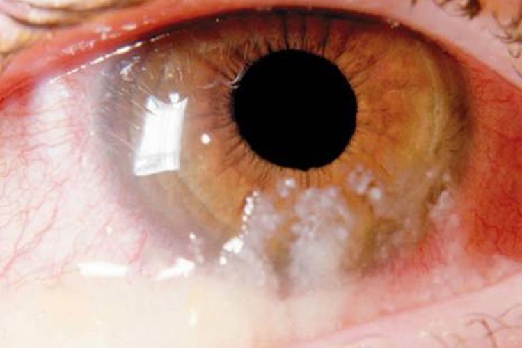 结膜炎膜或假膜图