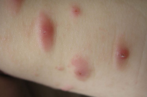 急性单纯性痒疹