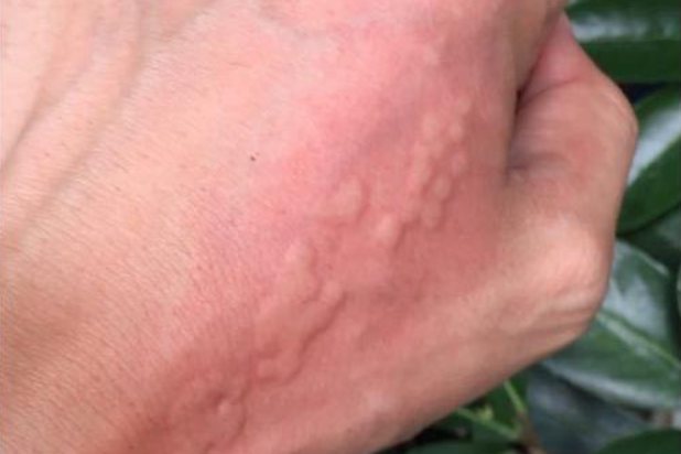 洋辣子蛰伤后图片