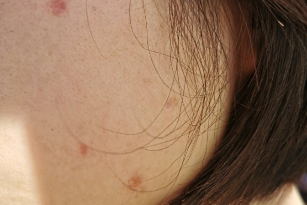 点痣痂掉了图片