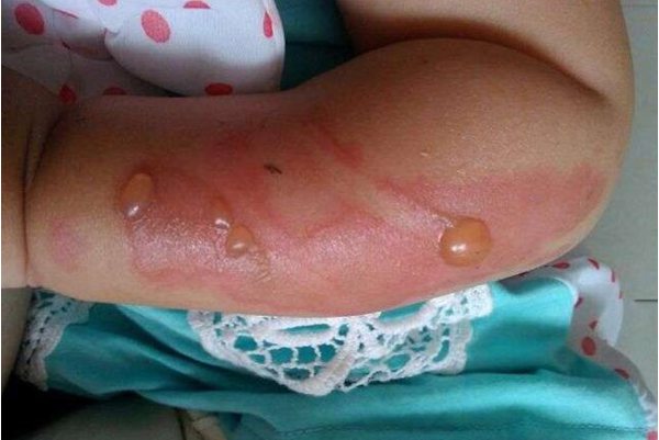 儿童开水烫伤图片