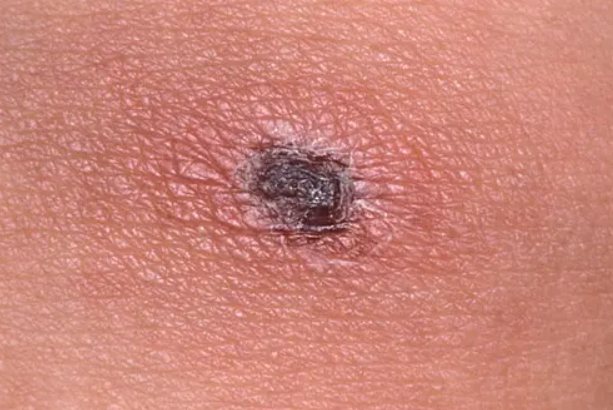 恙虫叮咬伤口图片