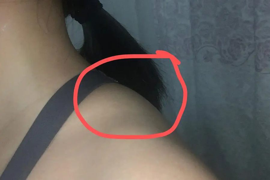 肩膀两边鼓起来两坨肉图片