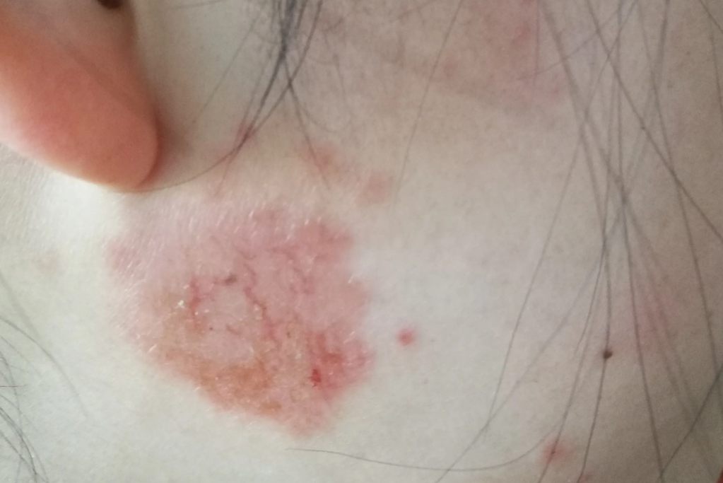 脸上红色的癣初期图片