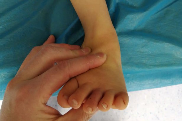 内因型轻微足内翻