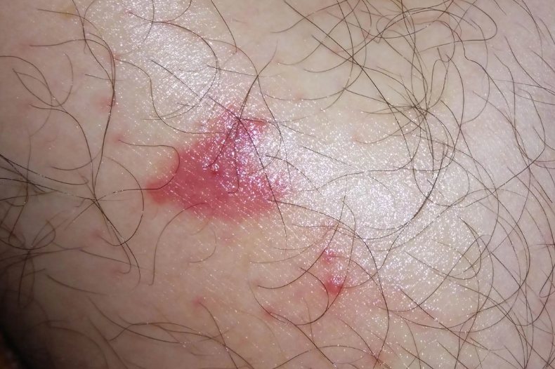 外伤皮下出血点