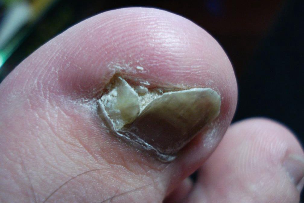 病毒感染甲分离症