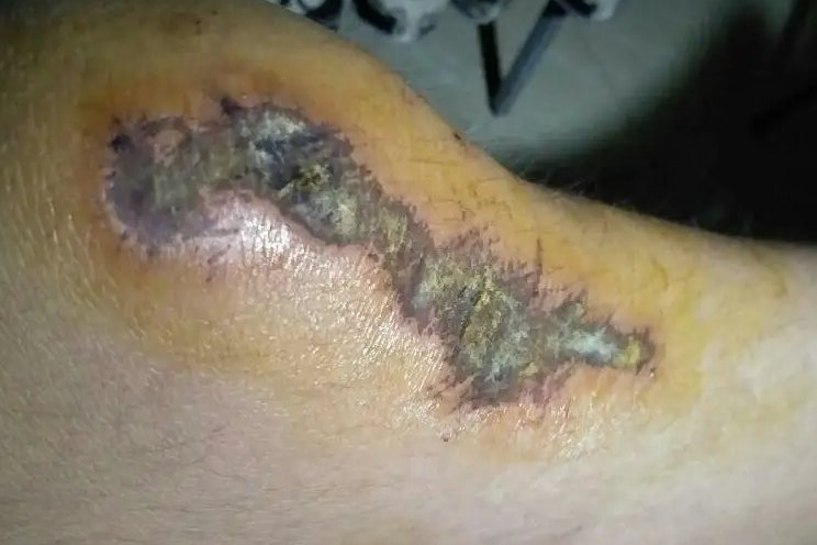 结痂是什么样子