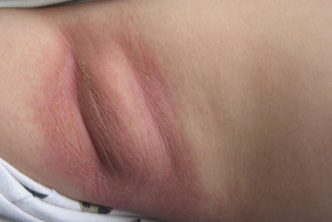 大腿接触性皮炎