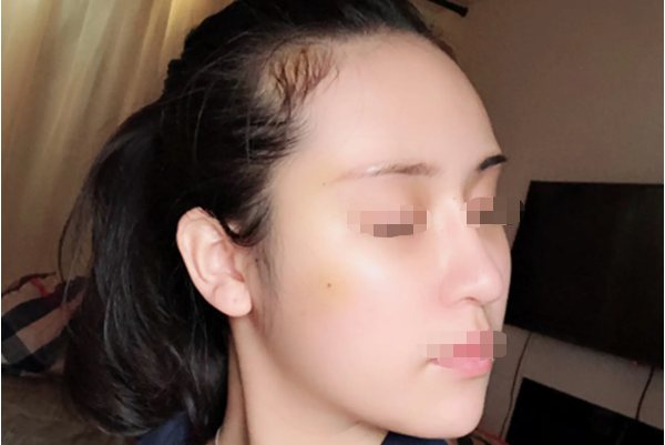 打眉骨针效果图