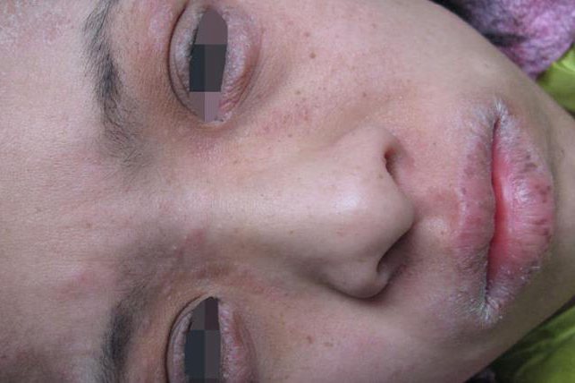 青年成人期变应性湿疹