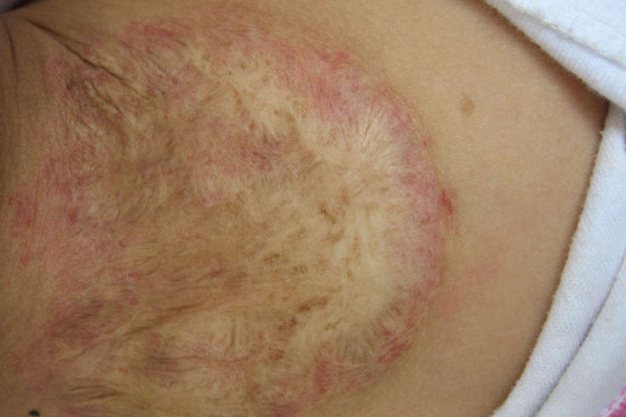 同位素留下白斑