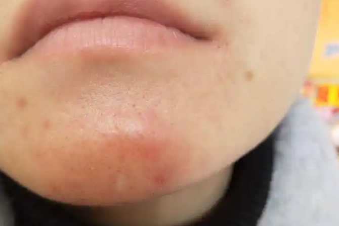 假体下巴发炎感染