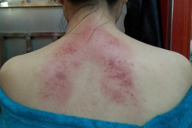 健康刮痧后背图