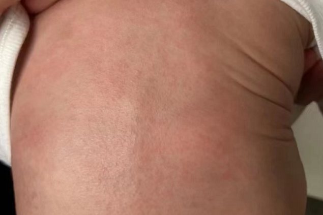 皮肤过敏