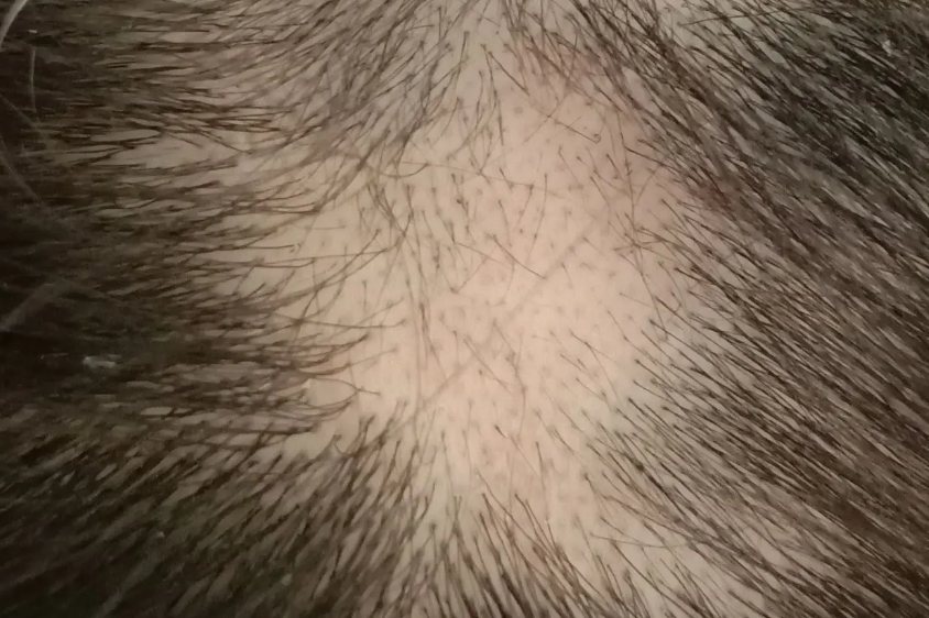 斑秃长出细小绒毛