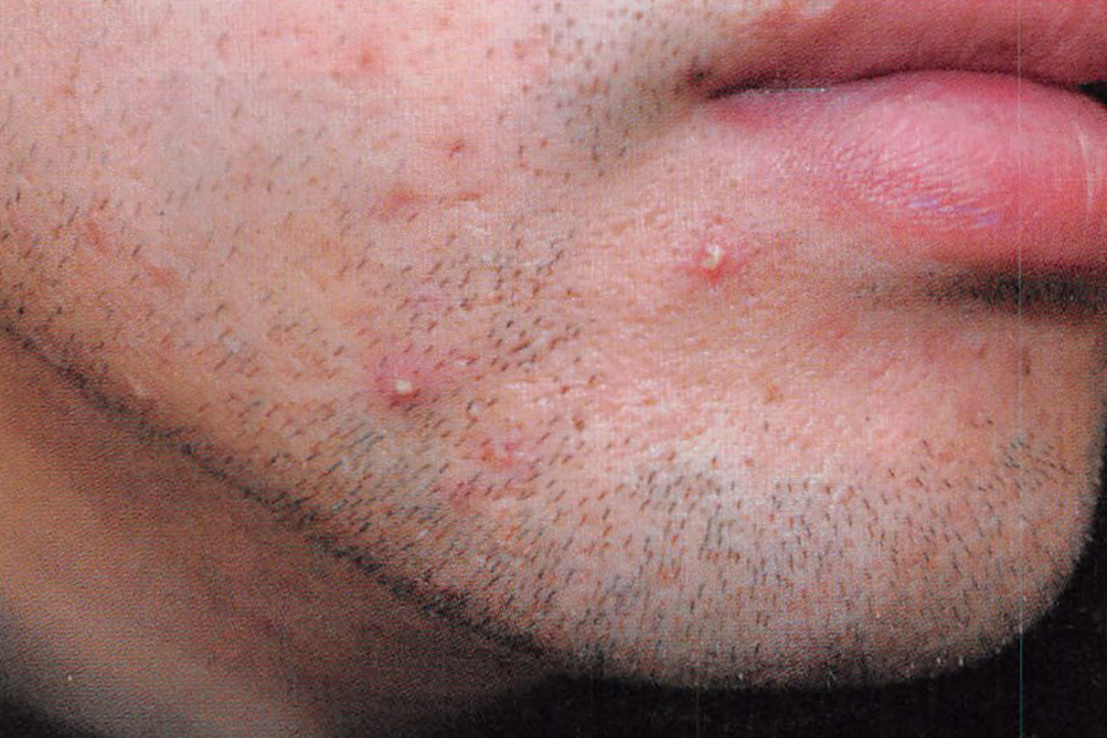 脸部毛囊炎的症状图