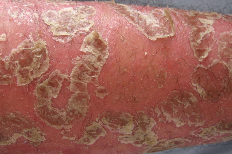 急性脱屑性皮炎