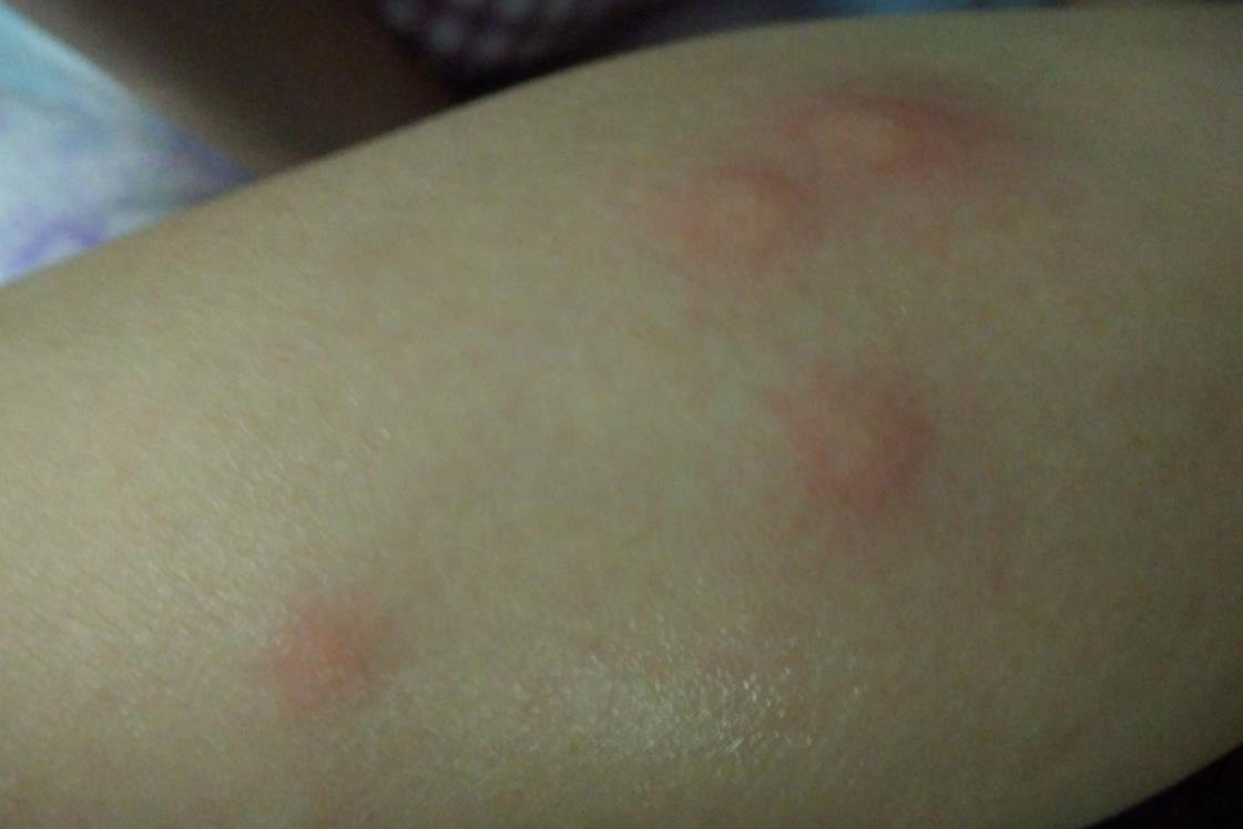 跳蚤咬完人是什么样子