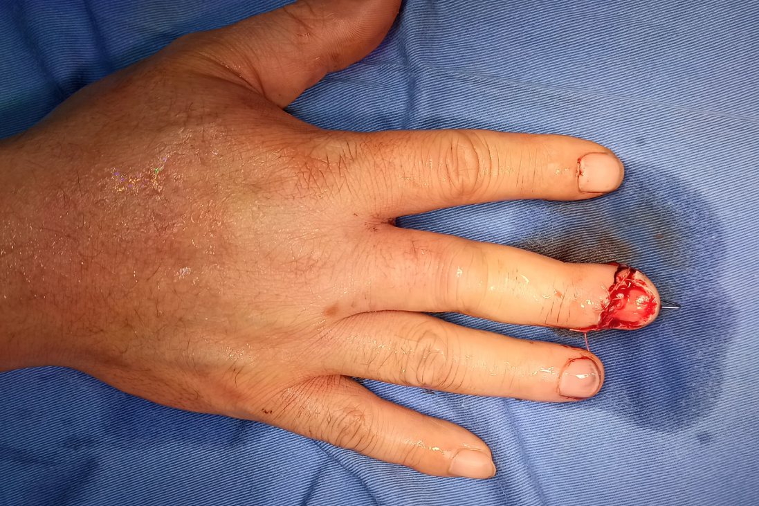 手指严重挤压伤肉撕裂