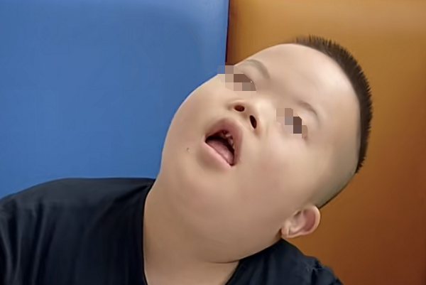 唐氏综合征