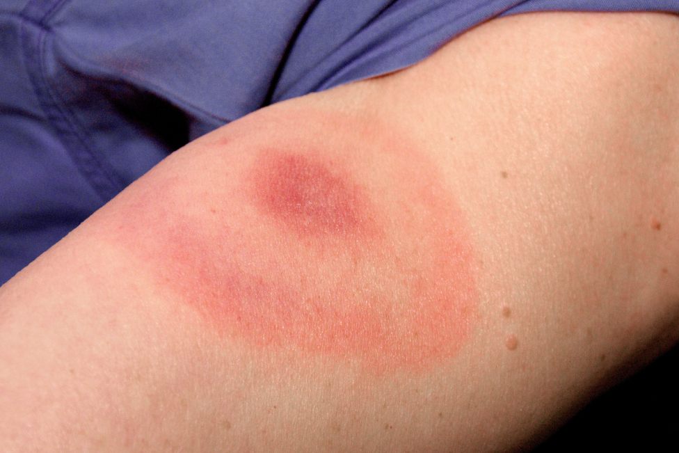 慢性游走性红斑