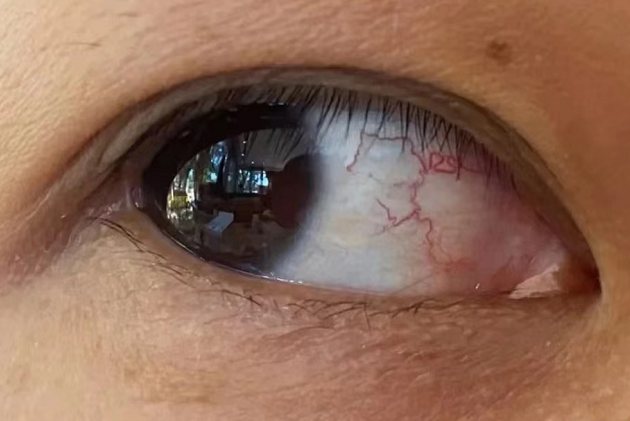 重度干眼症图片