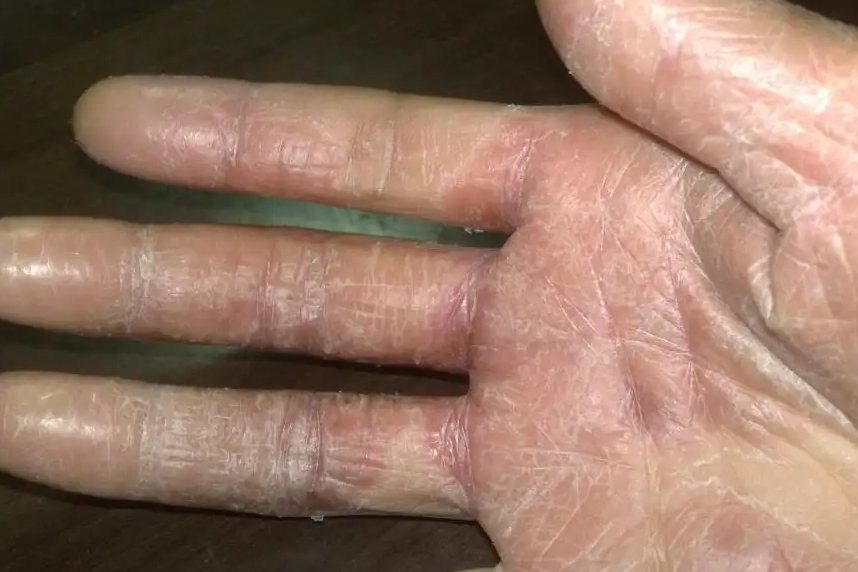 手掌角质层增厚硬化