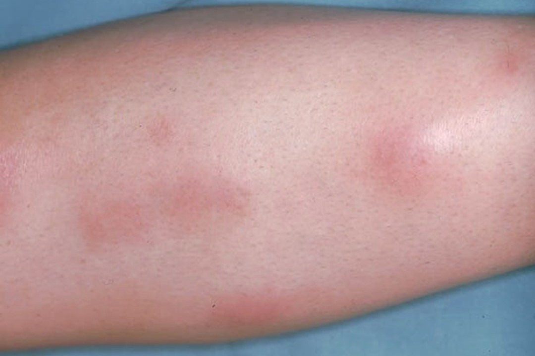 轻度结节性红斑