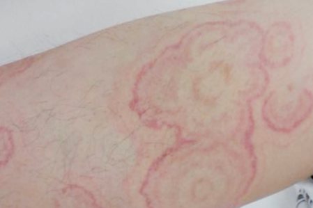 匐行性回状红斑