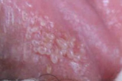 颗粒状假性疣