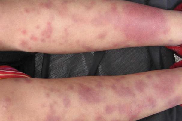 小腿红斑