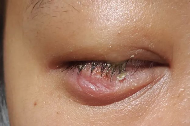 针眼切开排脓图片