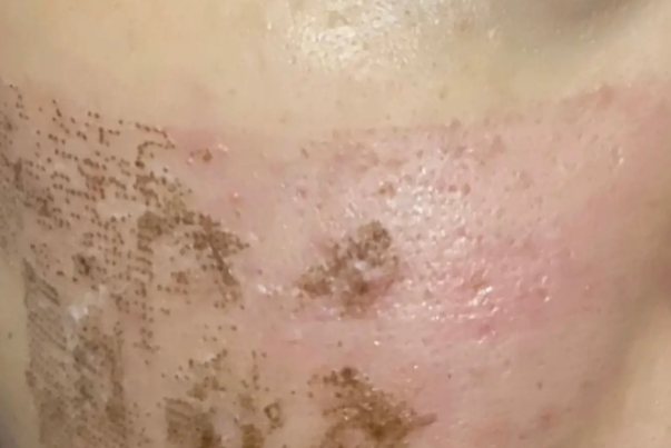 激光去胎记结痂脱落后图片