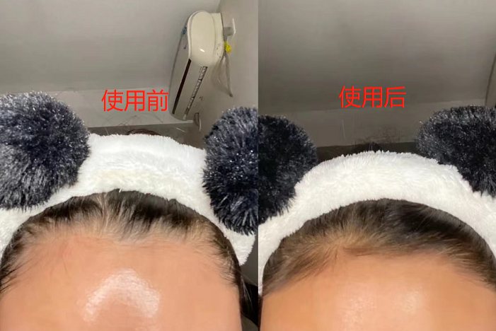 米诺地尔效果图