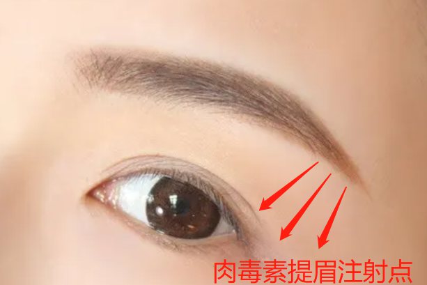 肉毒素提眉注射点图片