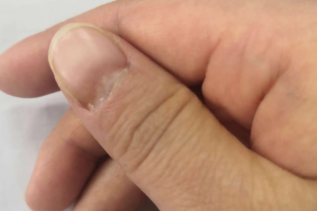 肢端血液循环障碍