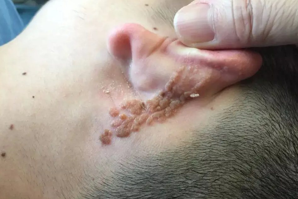 局限型胎生疣状痣