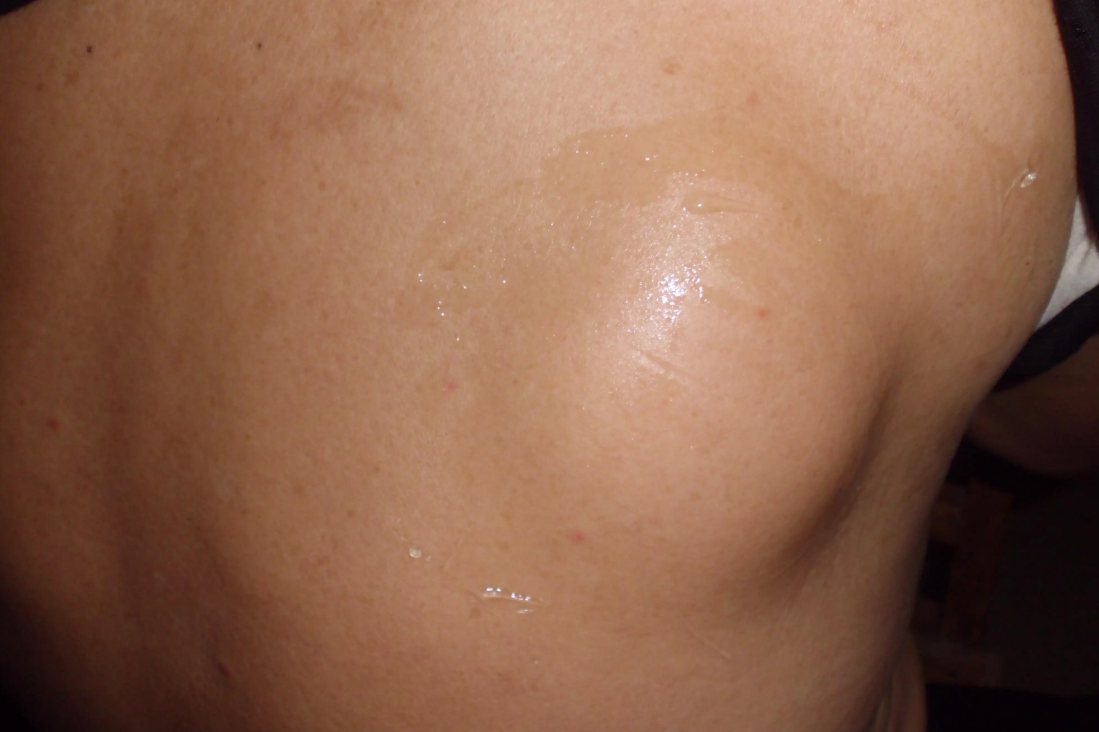 浅表性皮下脂肪瘤