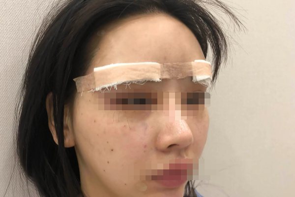 玻尿酸填充眉弓效果图