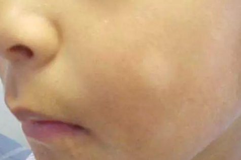 缺锌脸上的白斑