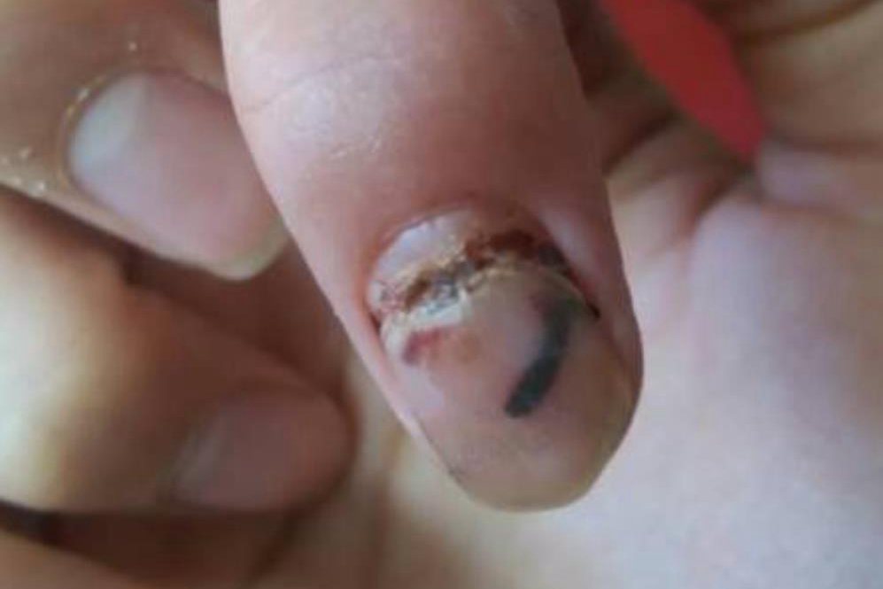 外力性甲床坏死