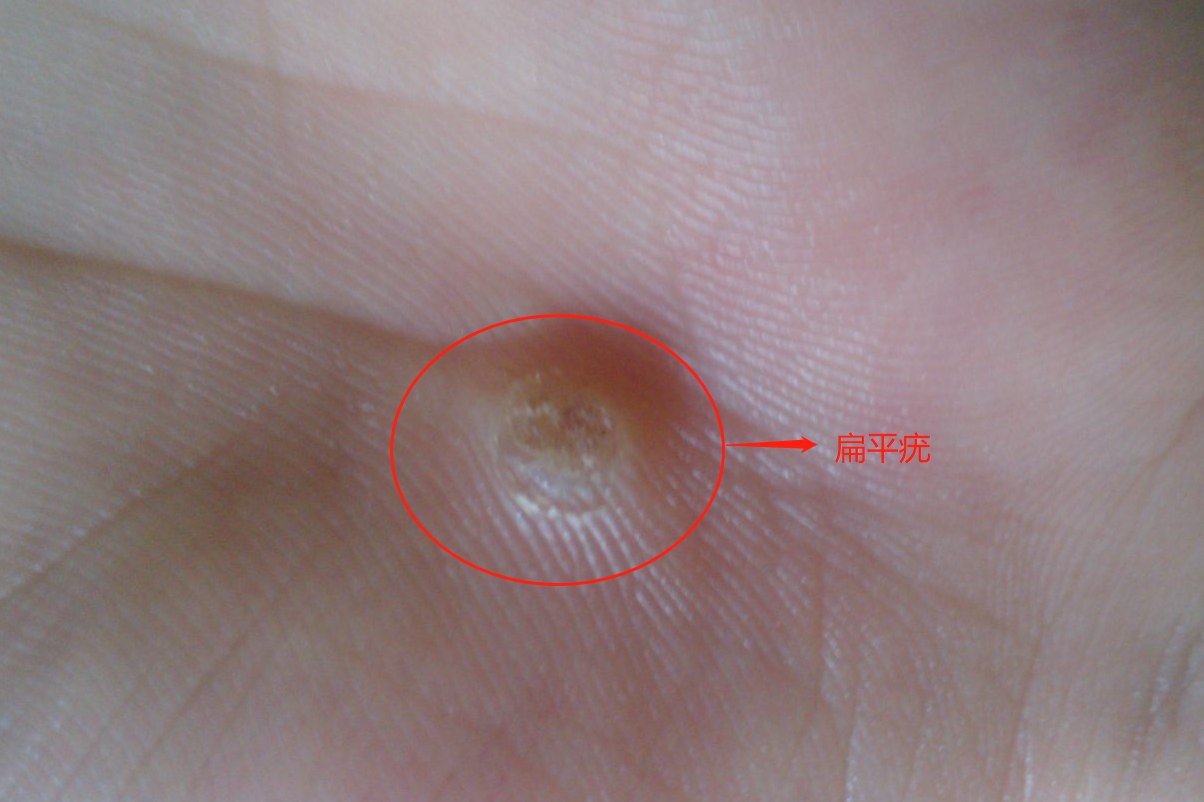 初期扁平疣