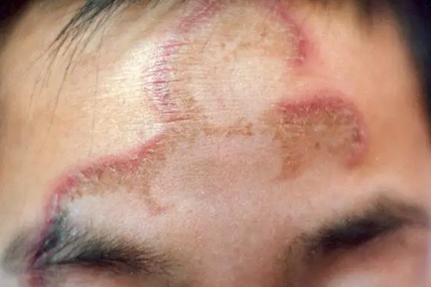 红斑狼疮疤痕状