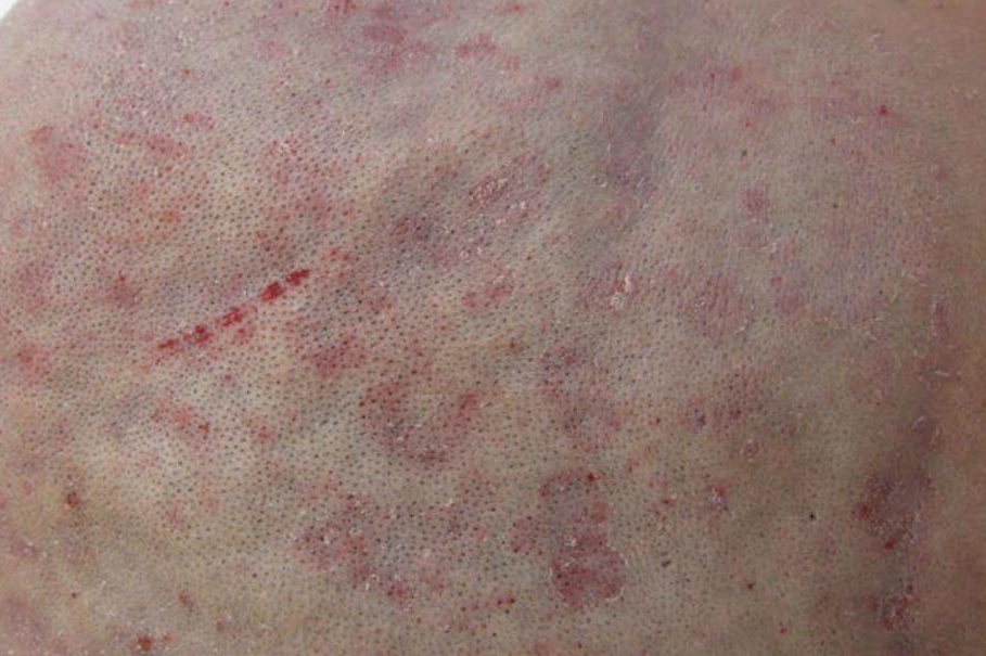 脂溢性皮炎早期症状