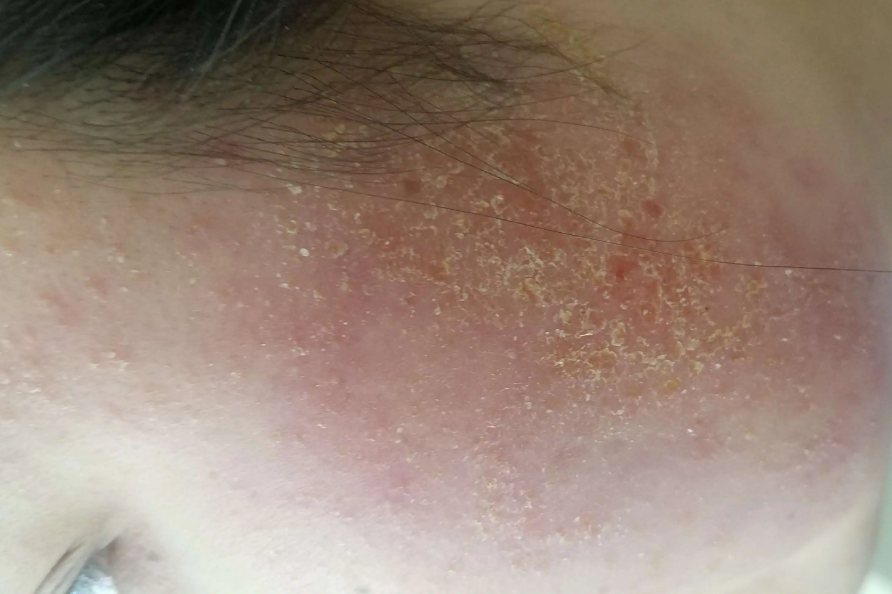 面部脂溢性皮炎