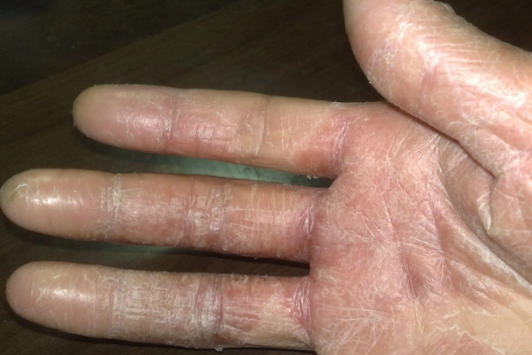 手指皮肤角化症图片