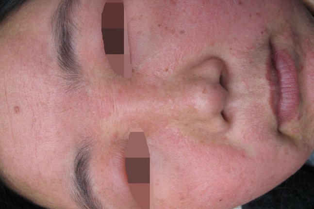 化妆品过敏的脸